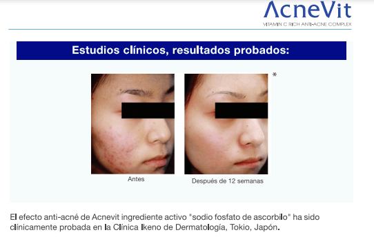 Resultados de 12 semanas de Suero Antiacné AcneVit contra acné y manchas rojas y marrones
