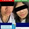 Testimonio del gel de limpieza para pieles mixtas a grasas dermaskin, antiacne