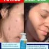 Testimonio del gel de limpieza para pieles mixtas a grasas dermaskin, antiacne