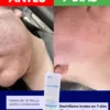 Resultados reales de la crema antiacné Centella asiática dermaskin