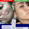 Resultados reales de la crema antiacné Centella asiática dermaskin