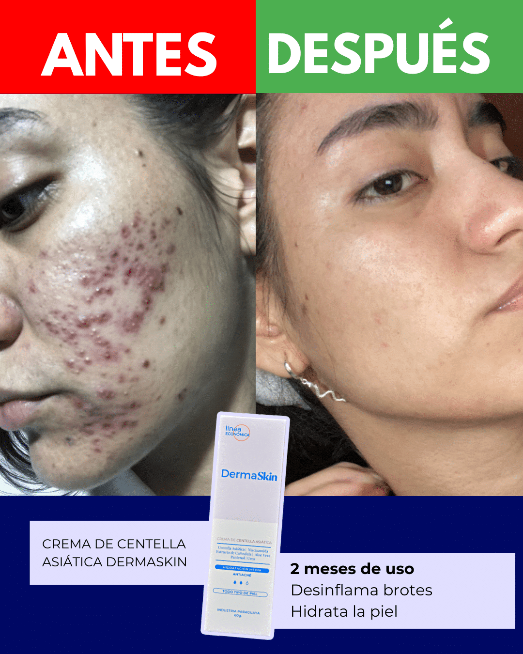 Resultados reales de la crema antiacné Centella asiática dermaskin