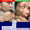 Resultados reales de la crema antiacné Centella asiática dermaskin