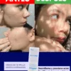 Resultados reales de la crema antiacné Centella asiática dermaskin