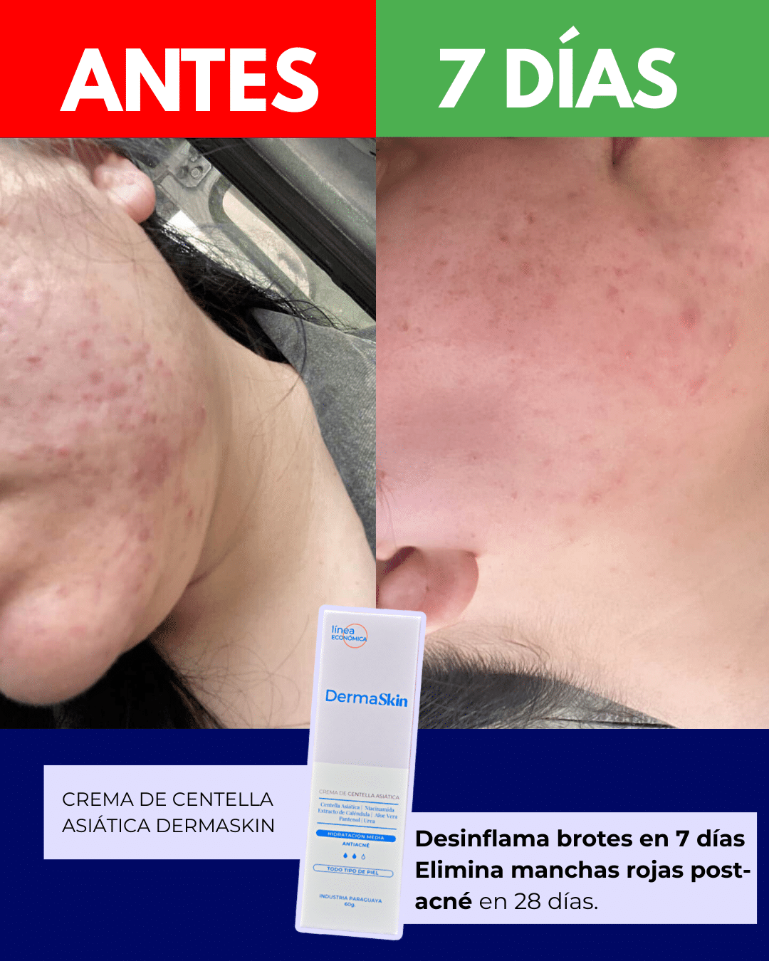 Resultados reales de la crema antiacné Centella asiática dermaskin