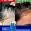 antes y despues del shampoo zerosebum, ayuda contra la caida y a que te crezca mas
